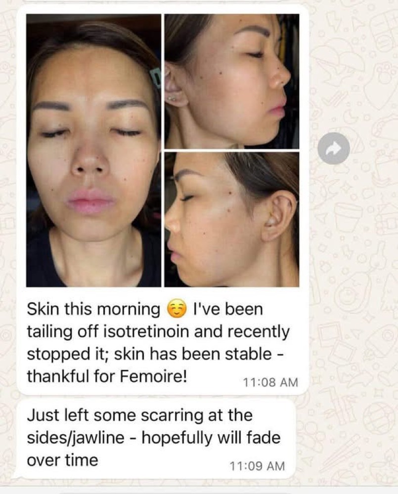 Customer WhatsApp: skin stable after tailing off isotretinoin, thankful for Femoire